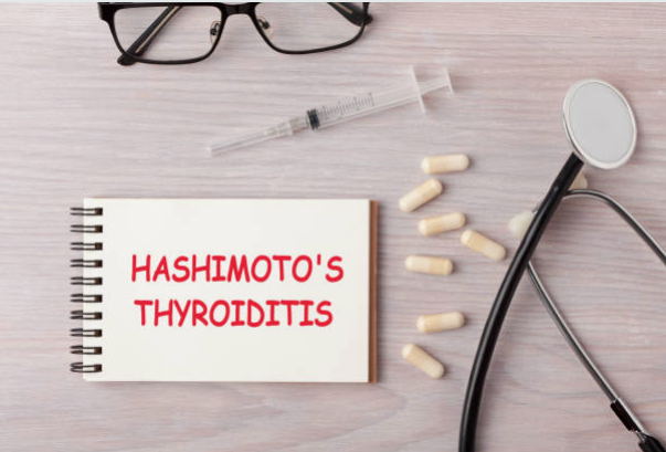Tiroiditis de Hashimoto, Síntomas